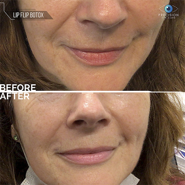 Botox Service Botox Treatments: What to Expect Before and After