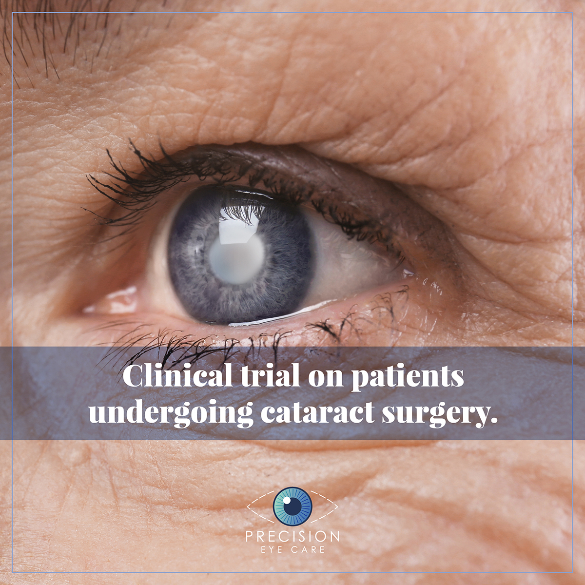 Clinical trial on patients undergoing cataract surgery.