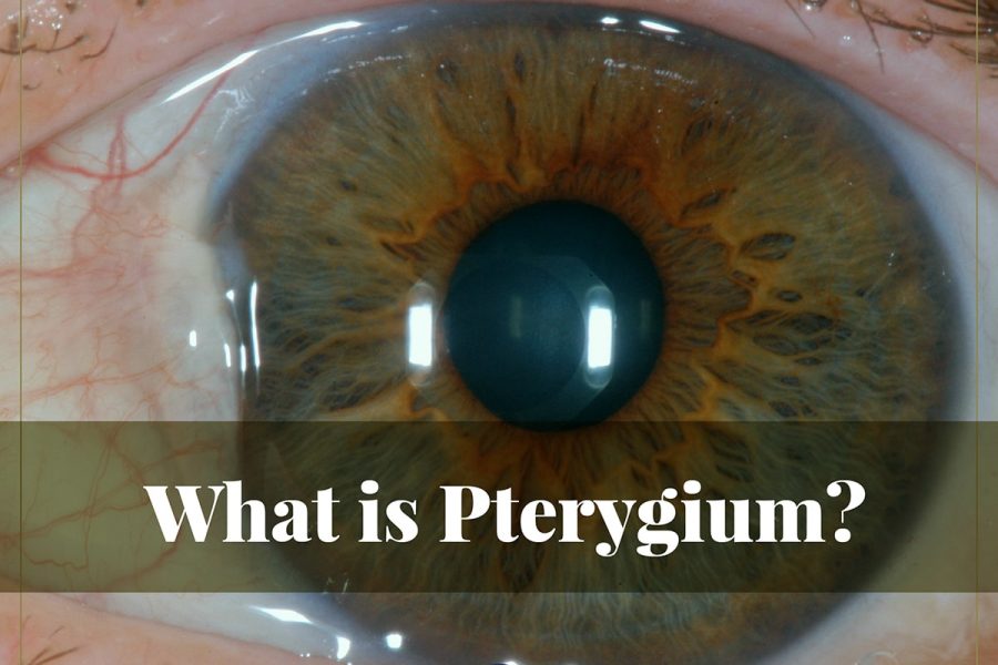 Pterygium