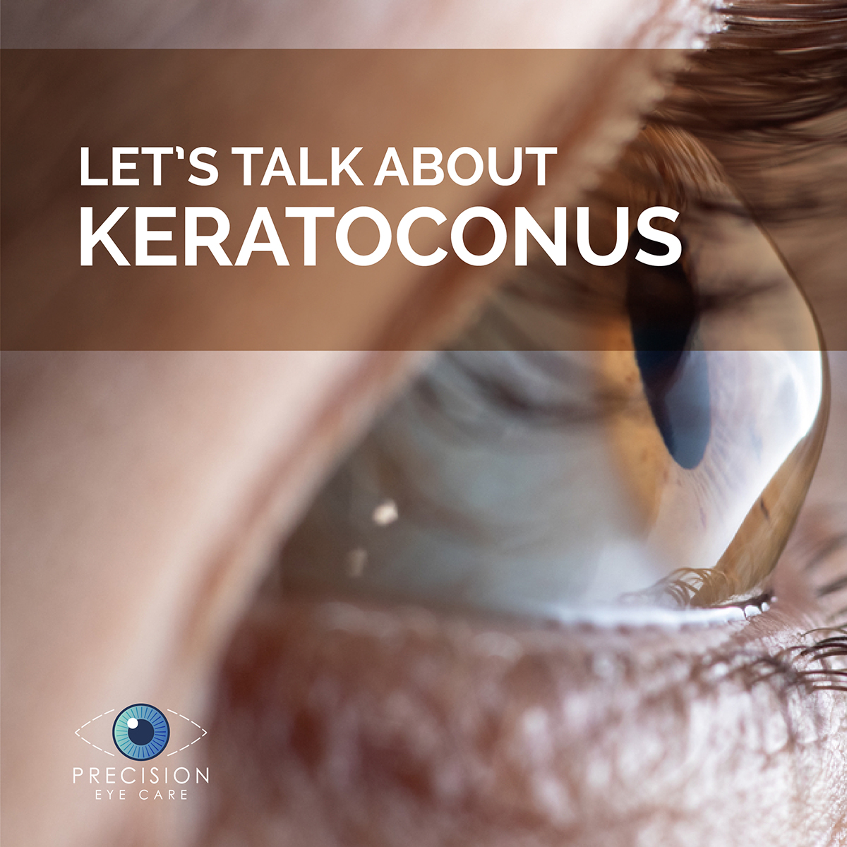 Keratoconus