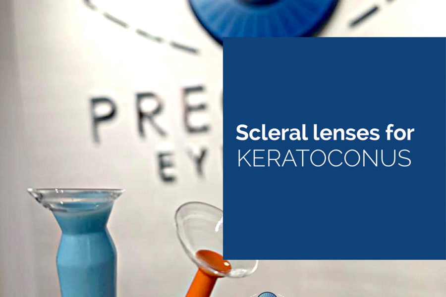 Scleral lenses keratoconus