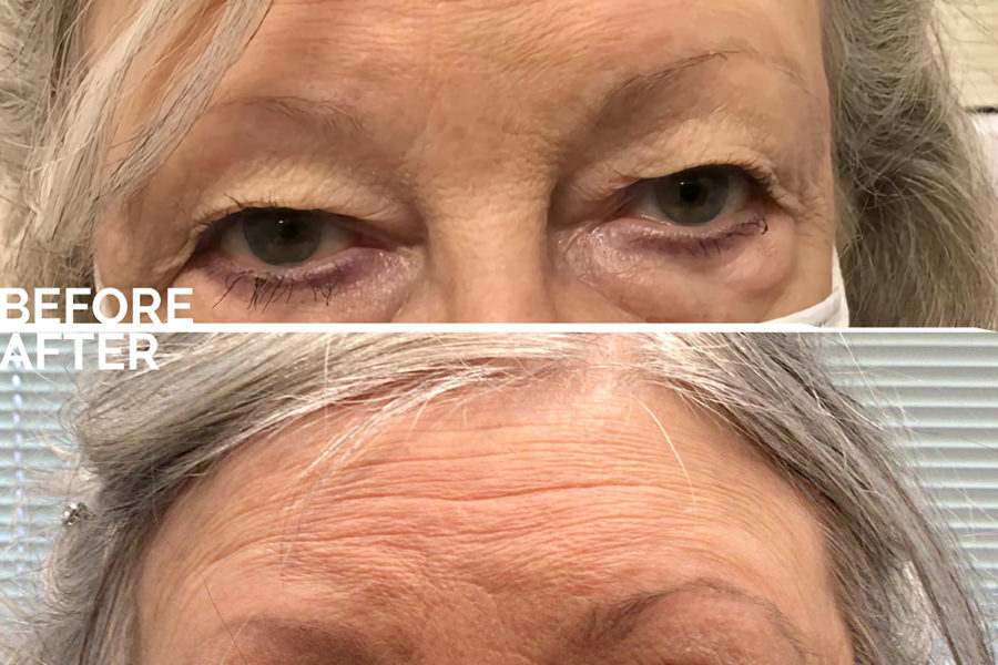 blepharoplasty