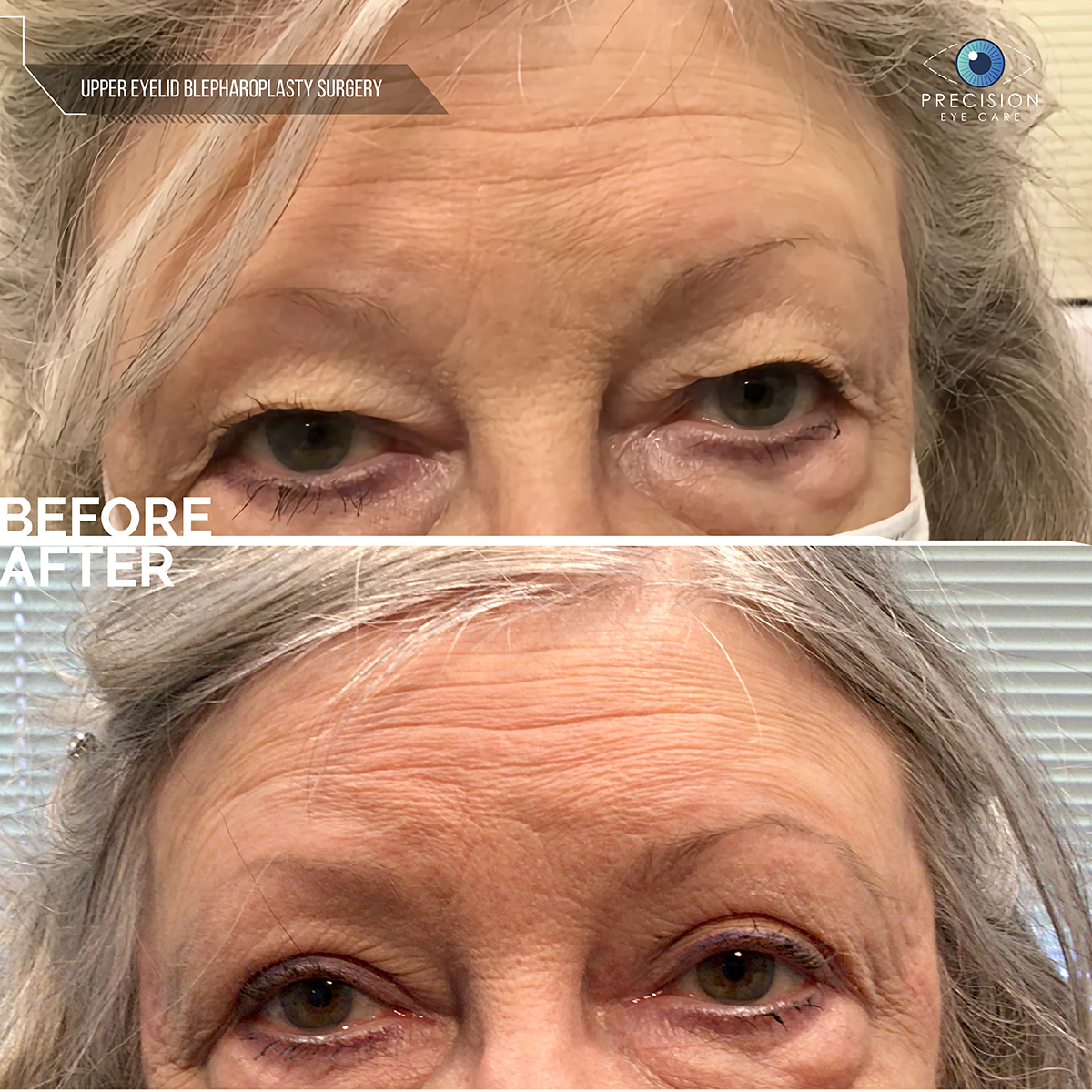 Blepharoplasty