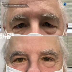 blepharoplasty