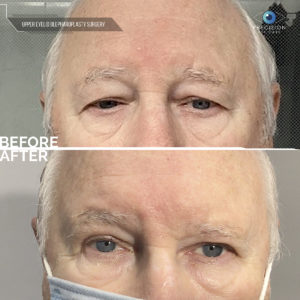 blepharoplasty