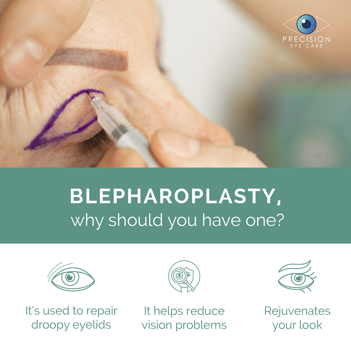 Blepharoplasty