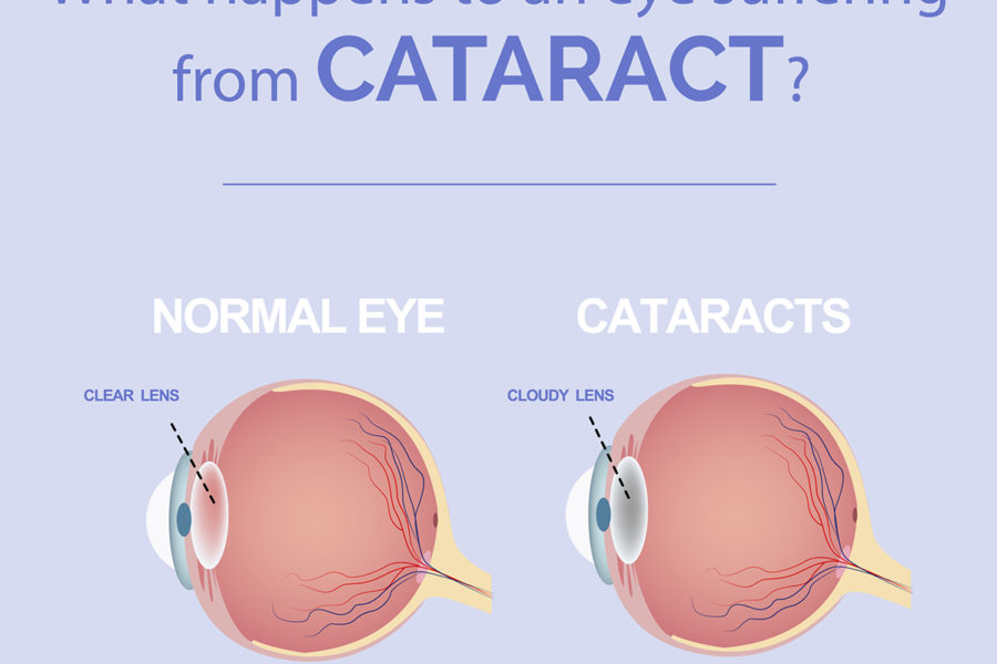 Cataract Eye