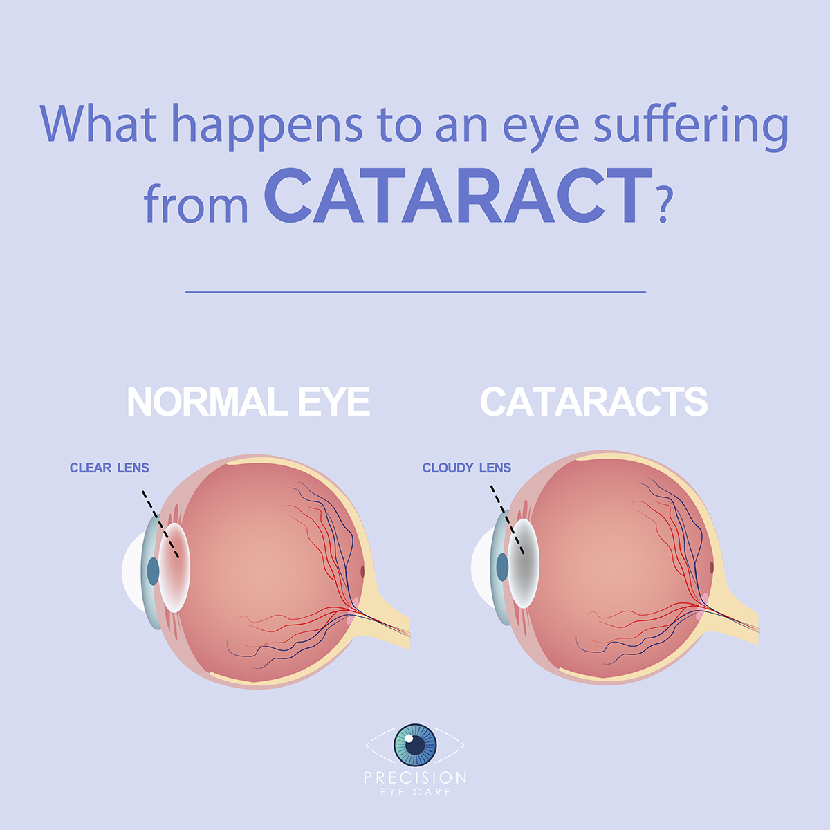 Cataract Eye