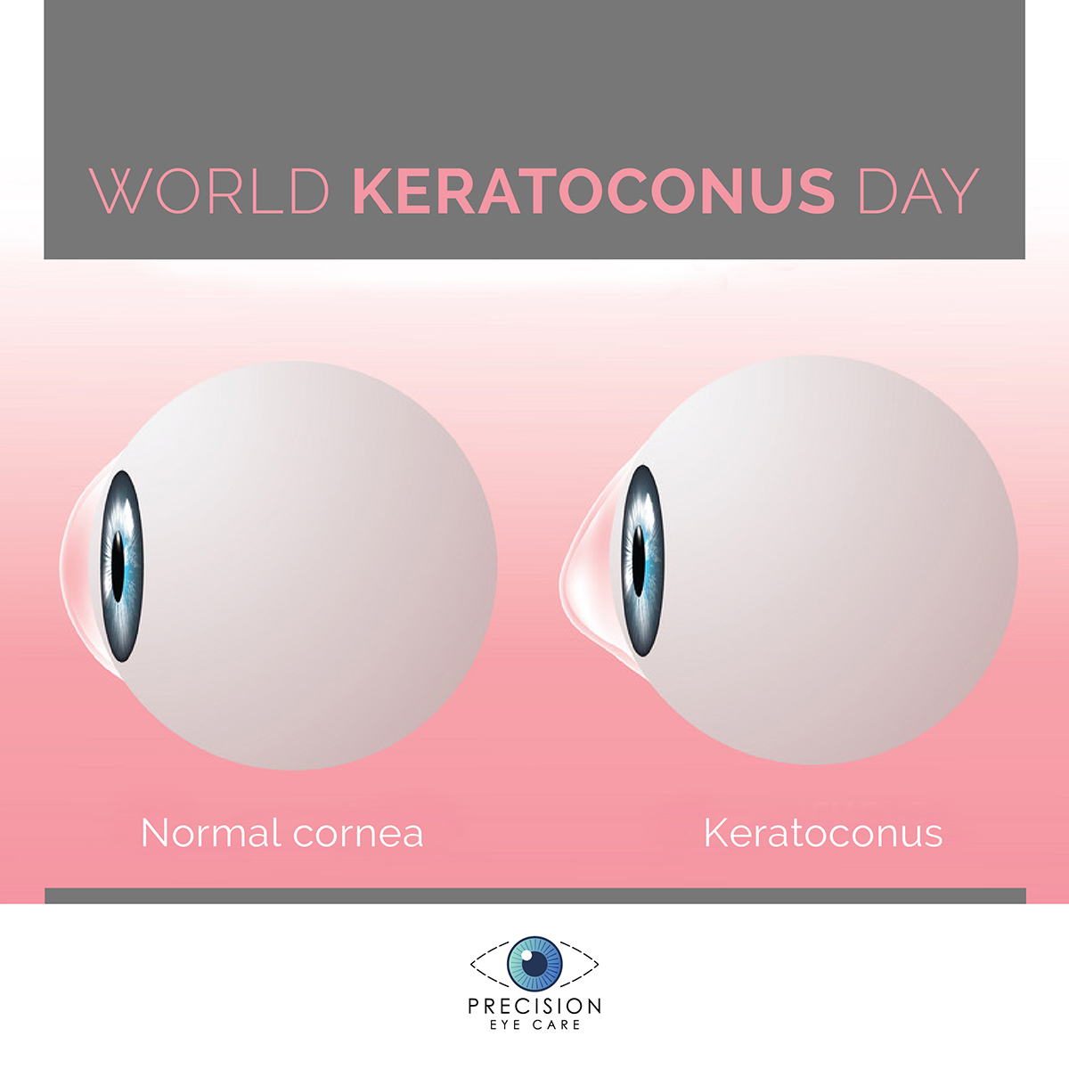 World Keratoconus Day