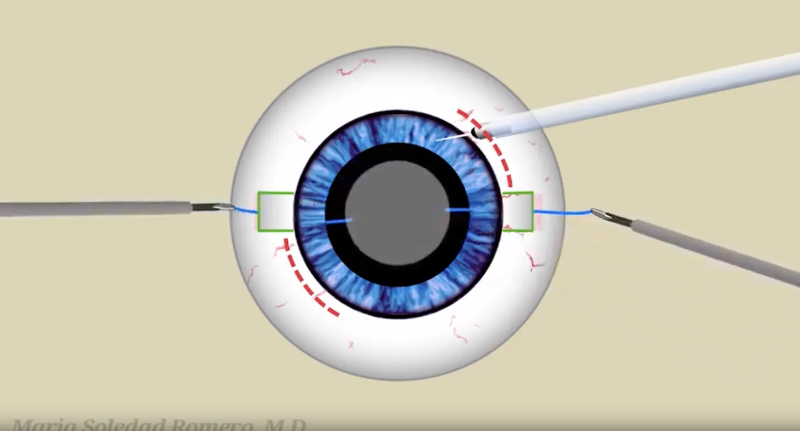 Complex Eye Procedures, Referrals & Second Opinions
