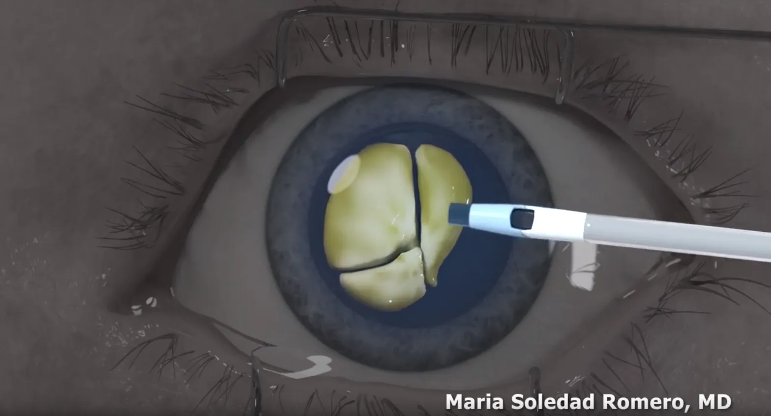 Precision Eye - Cataract and Laser Eye Surgery - Optometrist - Baltimore