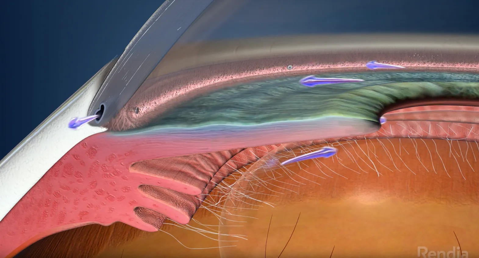 Glaucoma - Precision Eye - Cataract and Laser Eye Surgery - Optometrist -  Baltimore