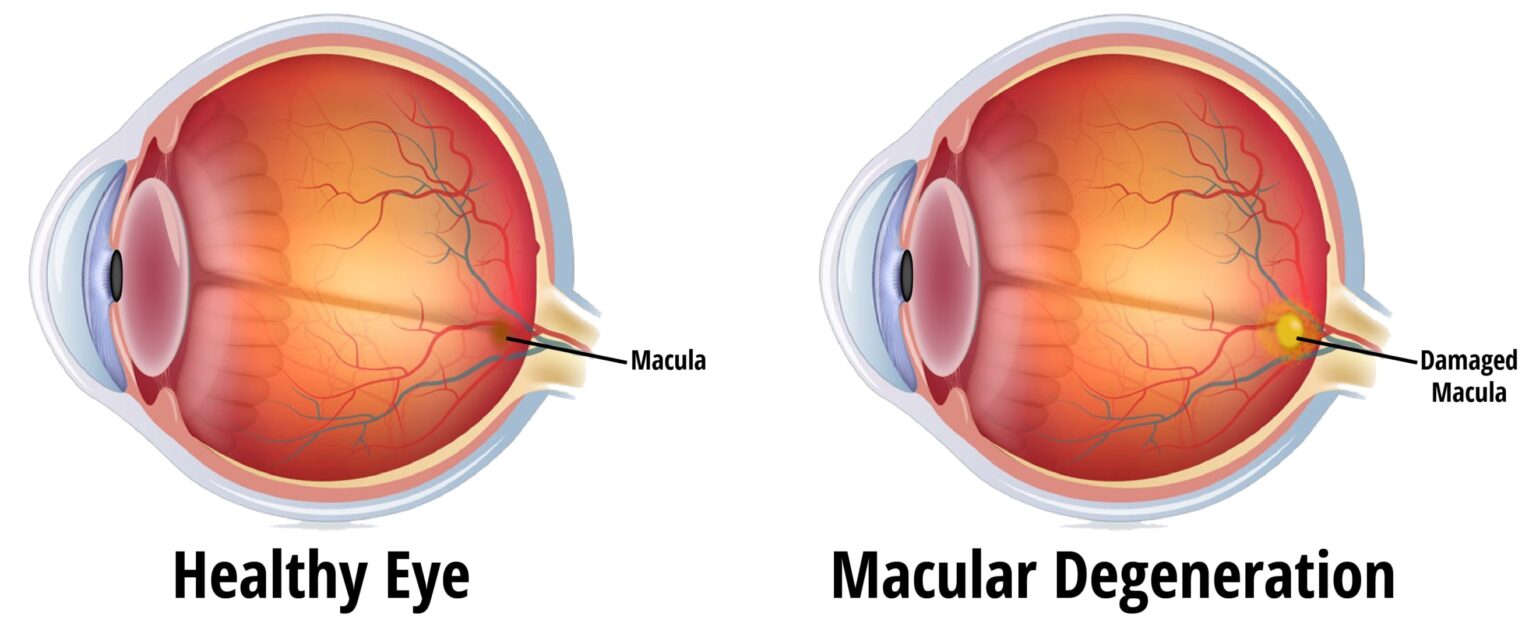 What is macular degeneration? Precision Eye Care MD