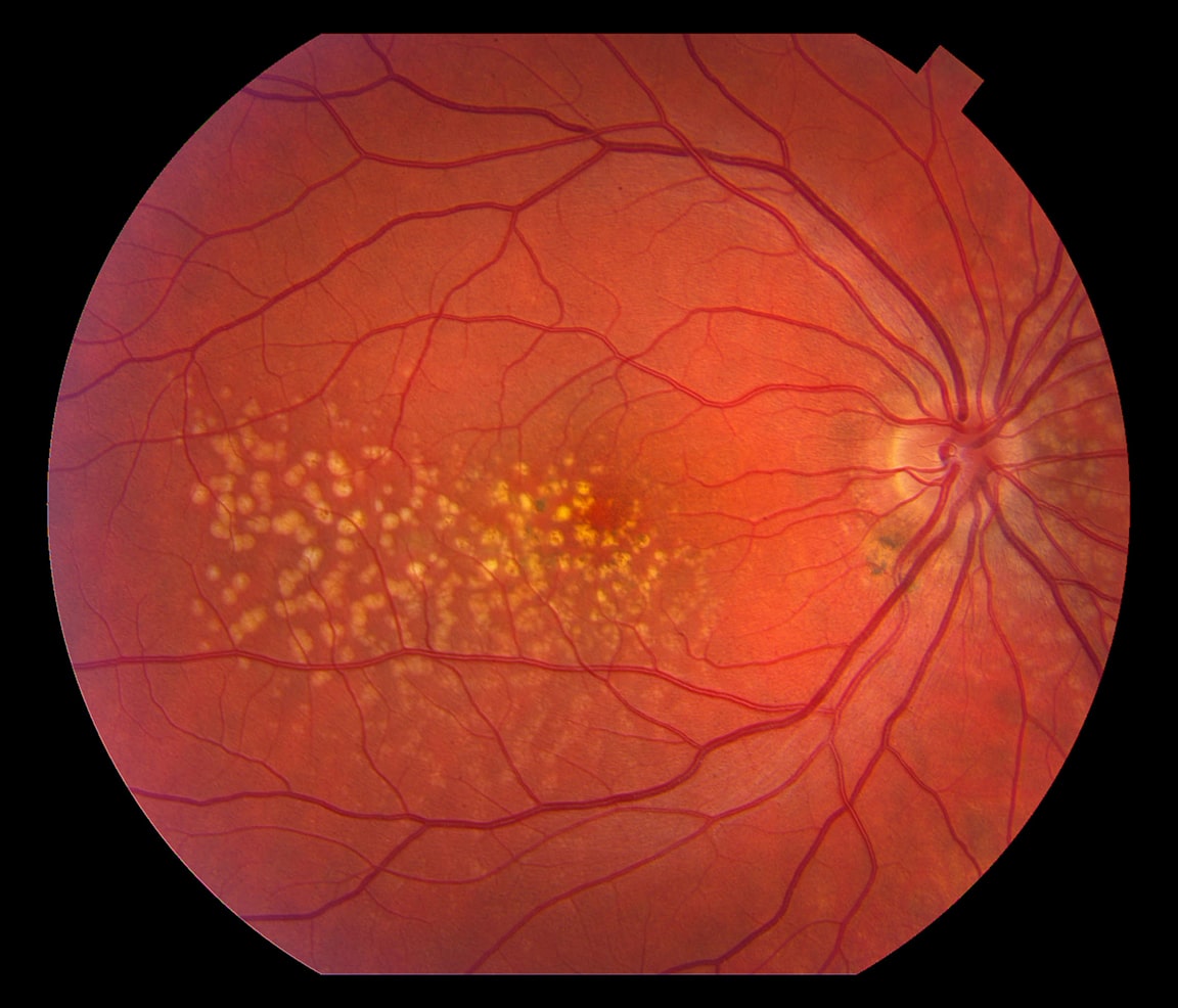 What is macular degeneration?