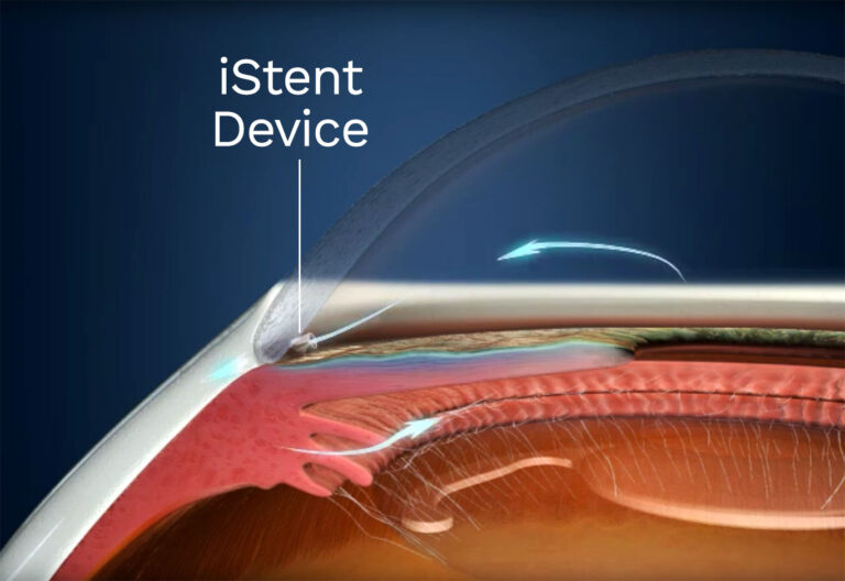 What Is Elevated Intraocular Pressure (IOP) - Precision Eye Care MD