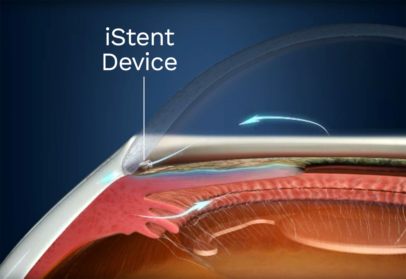 Istend device glaucoma