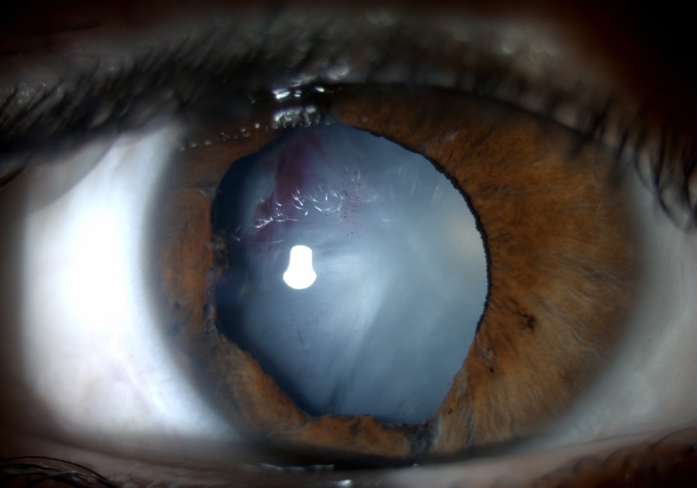 White cataract surgical removal with phacoemulsification