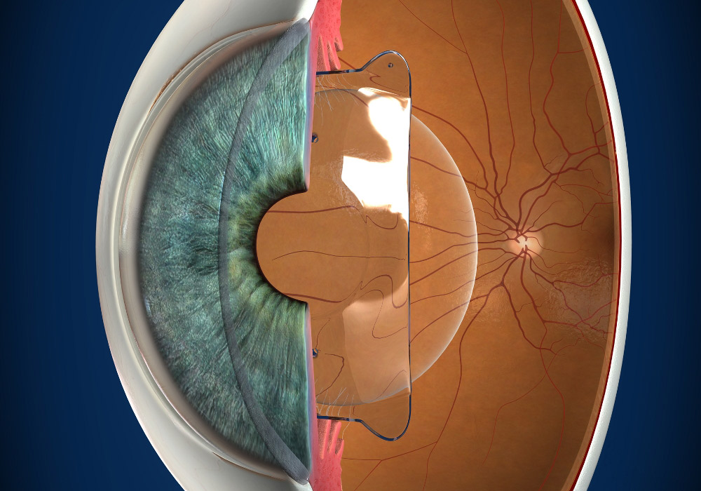 Implantable Collamer Lenses (ICLs)