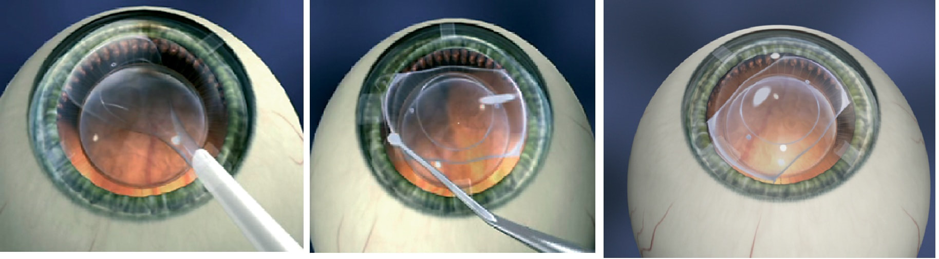implantation ICL lens