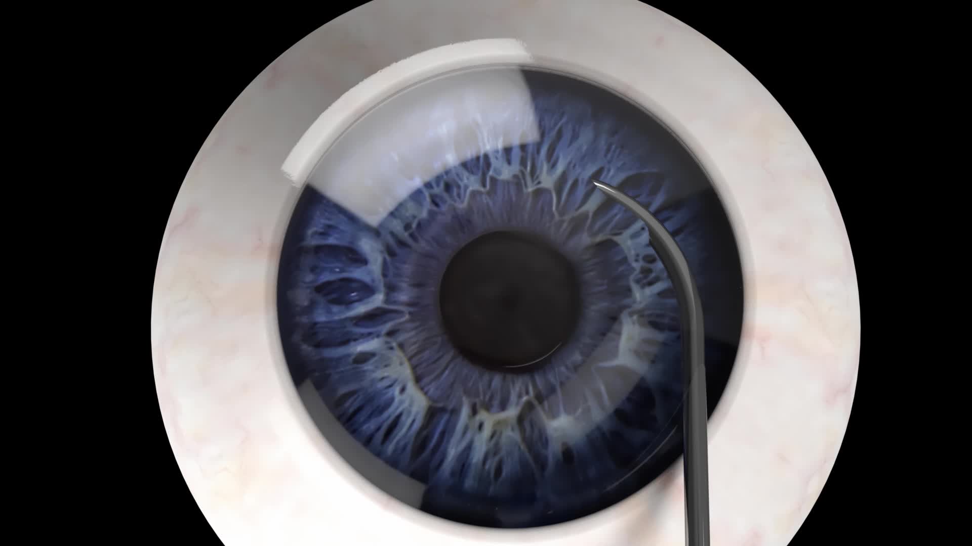 Minimally invasive glaucoma surgery (MIGS)