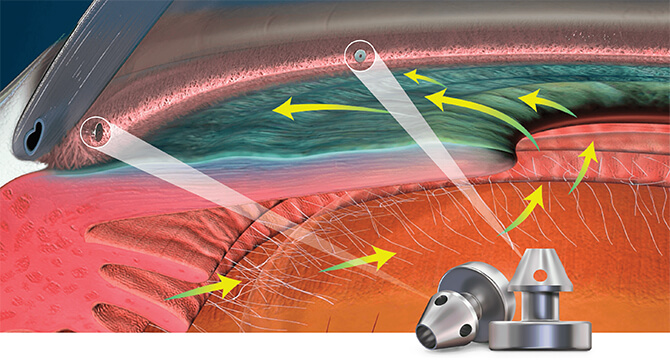 MIGS – Minimally invasive glaucoma surgery – iStent® by Glaukos