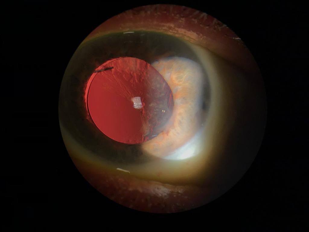 Can cataracts grow back?