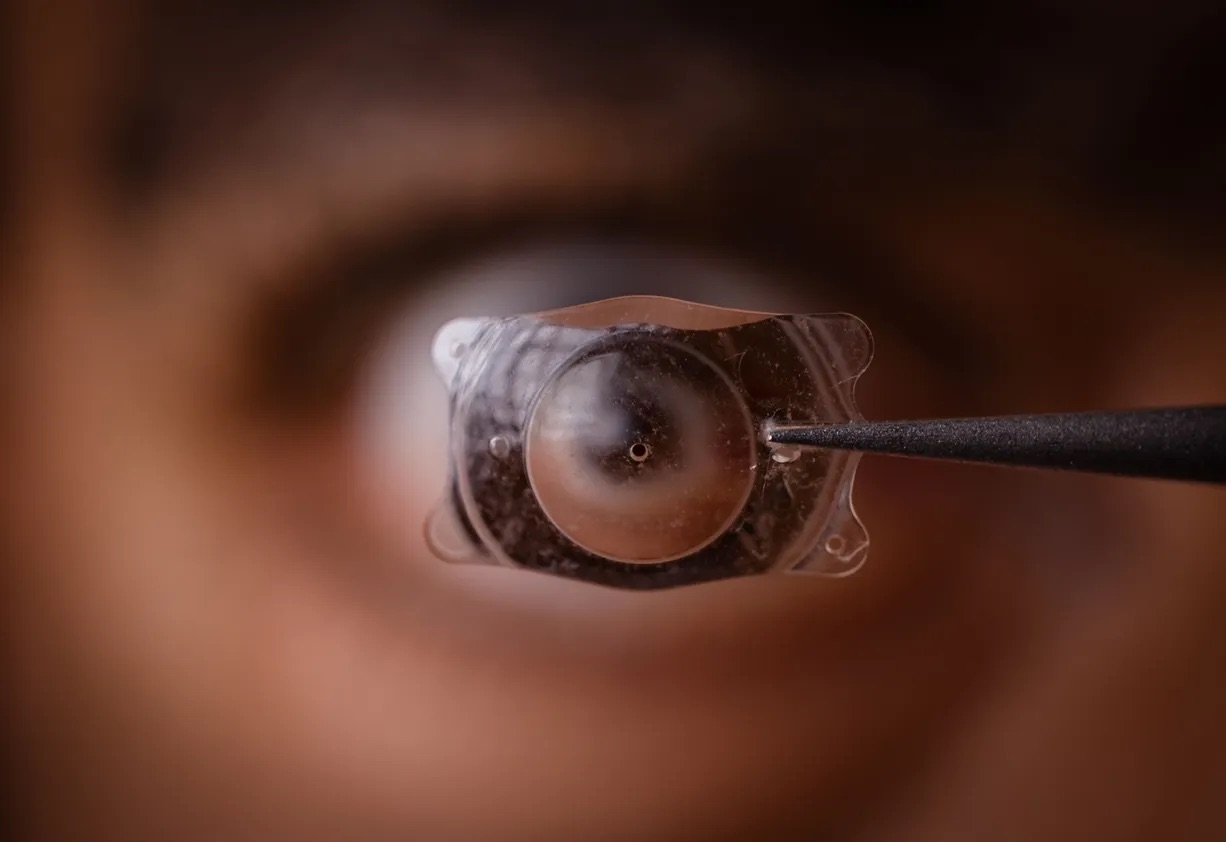 EVO ICL: A Solution for Dry Eyes