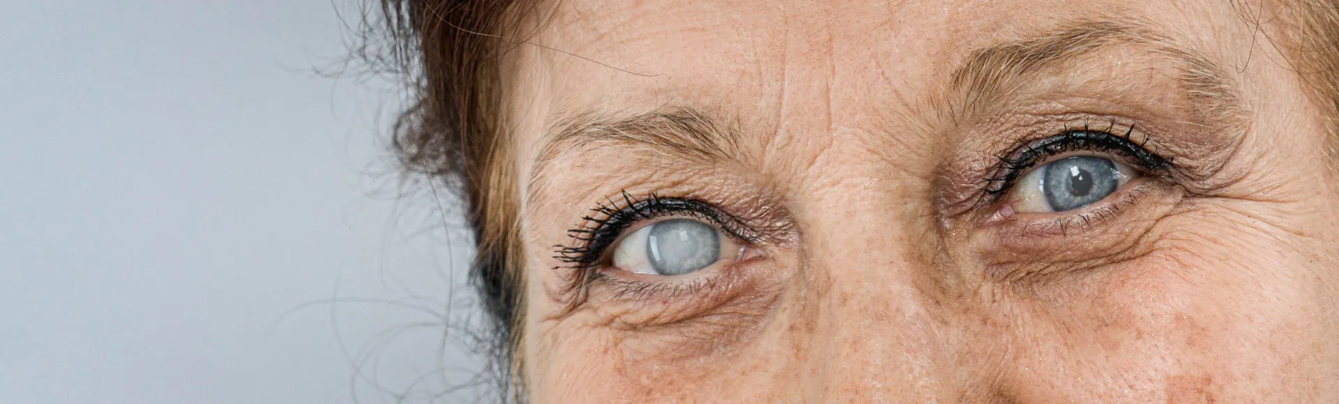 How Long Can You Leave a Cataract Untreated?
