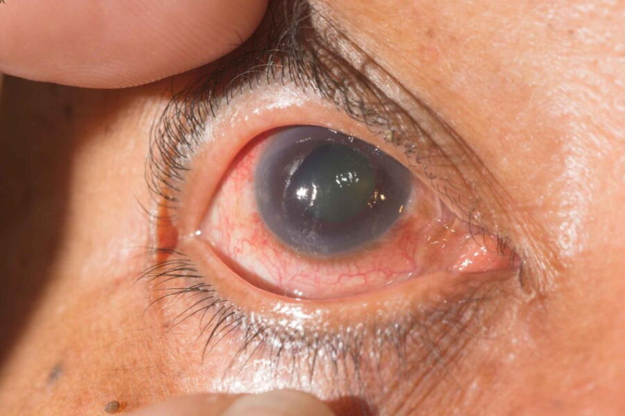 glaucoma early detection