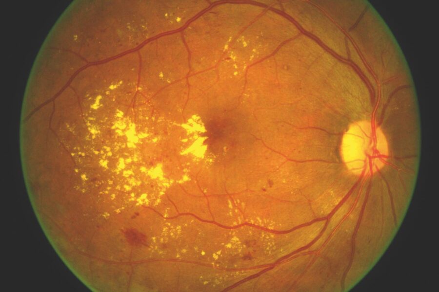 Maculopathy