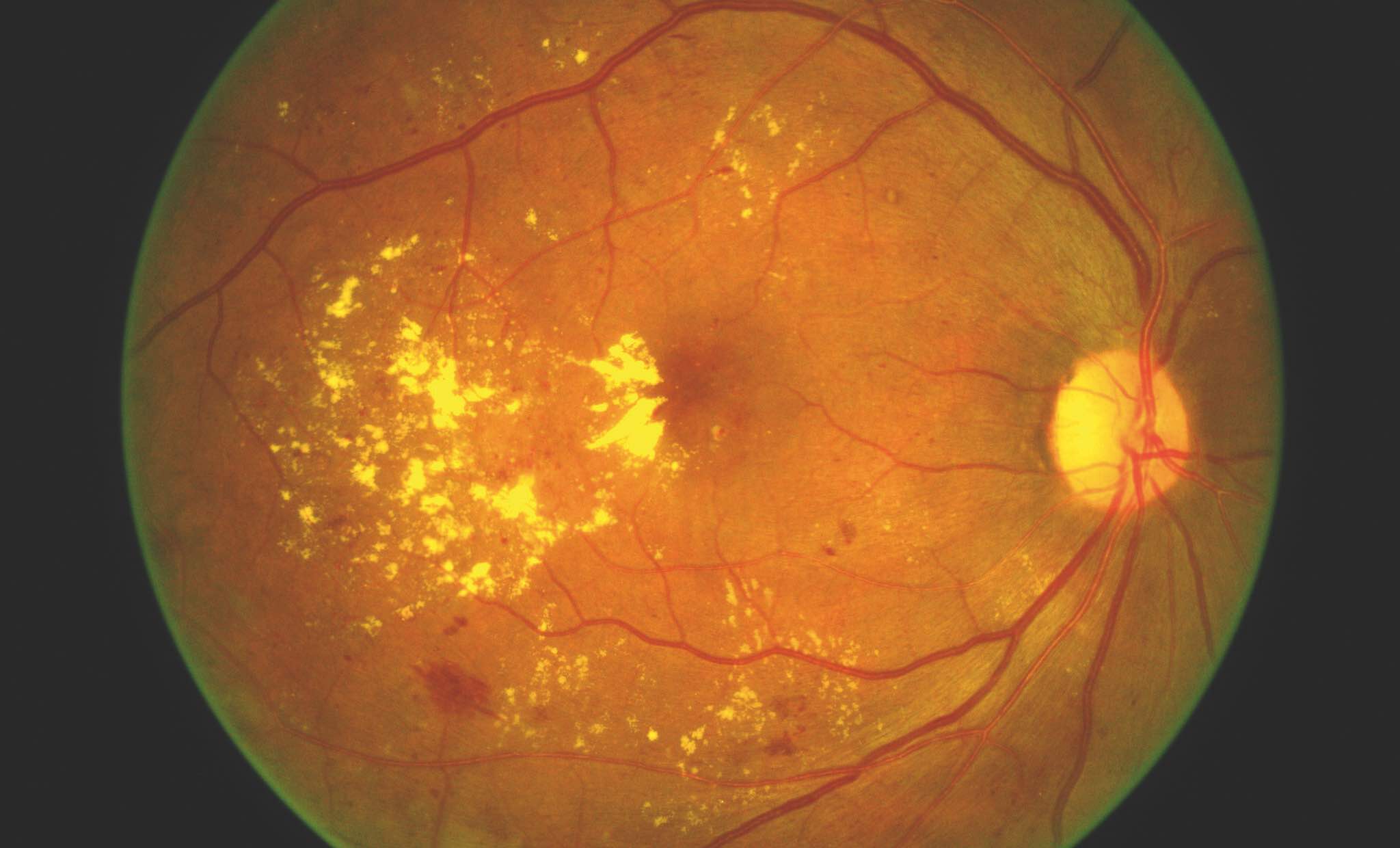 Diabetic Maculopathy: Precision Medical & Surgical Care