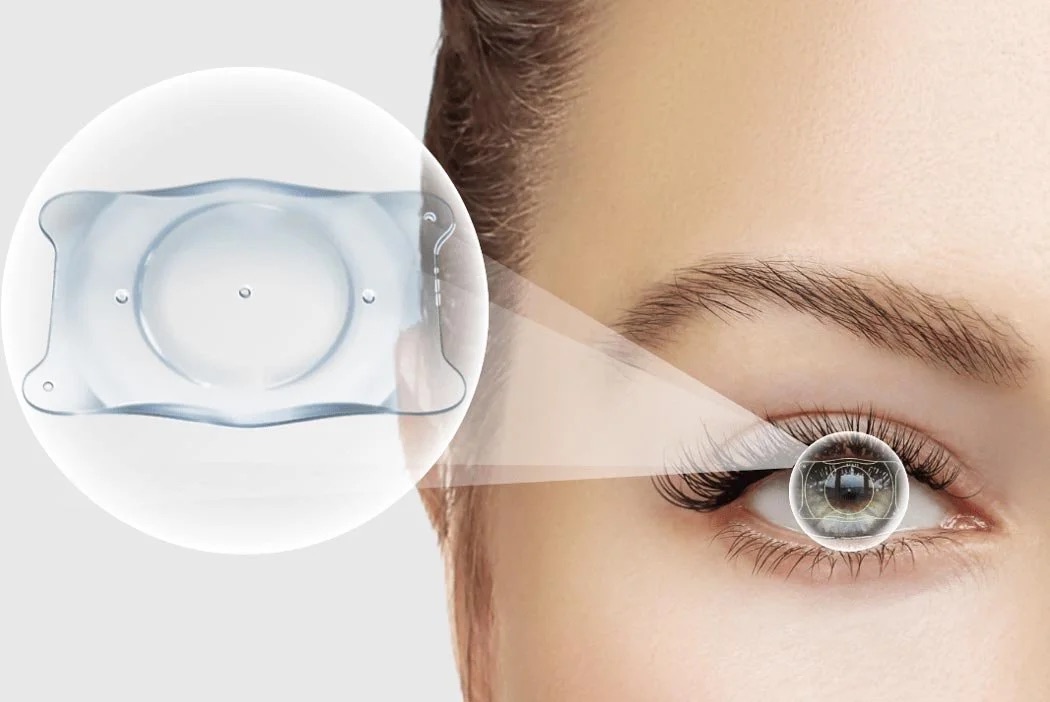 Is Lens-Based Vision Replacing Corneal Refractive Surgery?