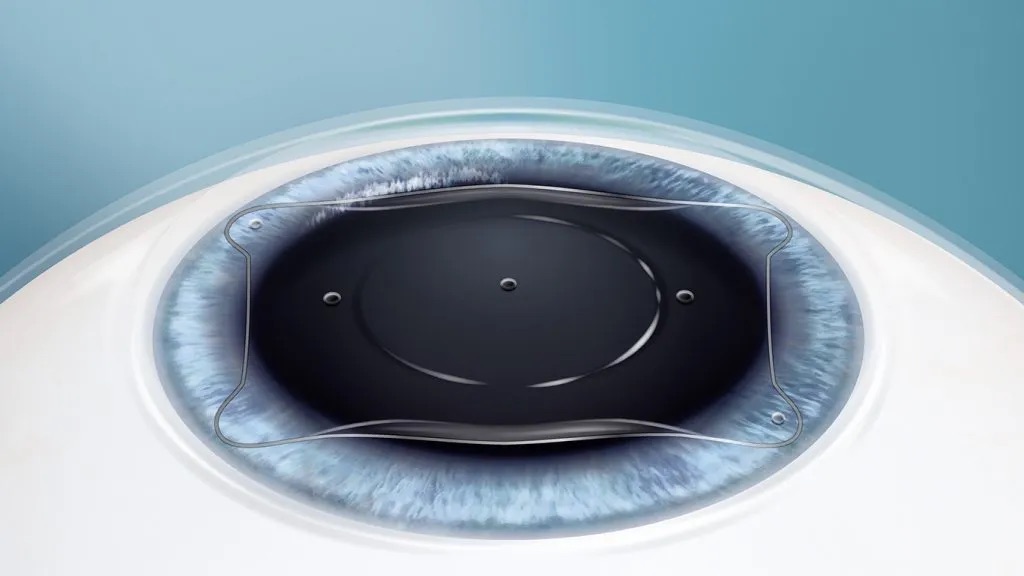 Choosing the Right Cataract Lens for Your Lifestyle