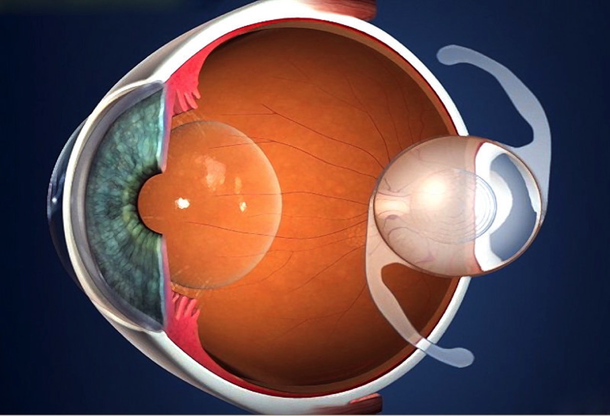 IOL INTRAOCULAR LENS
