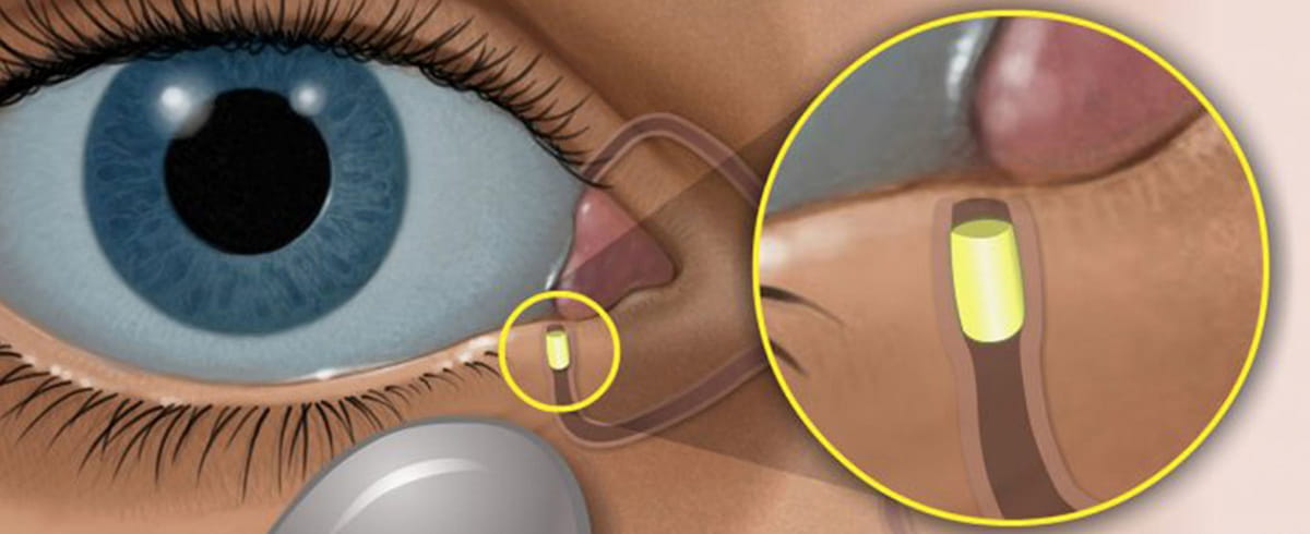 Fast Relief for Eye Allergies: Modern Treatments That Work