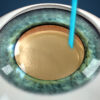 Micro-Invasive Cataract Surgery