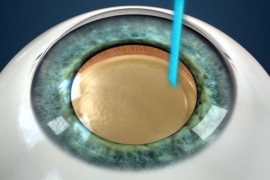 Micro-Invasive Cataract Surgery