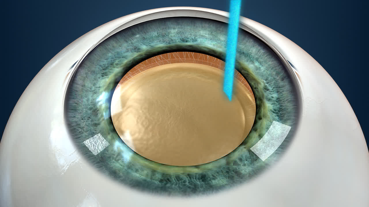 Micro-Invasive Cataract Surgery: Safer Vision Recovery