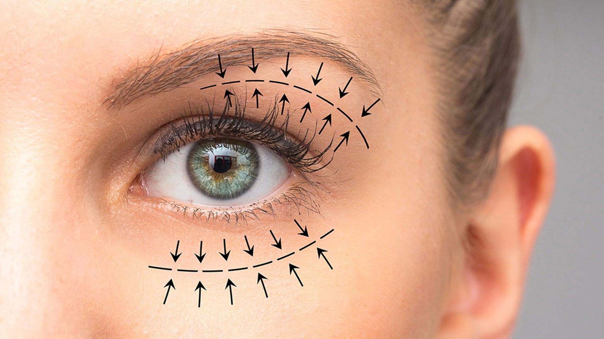 Blepharoplasty & IPL for Dry Eye Relief