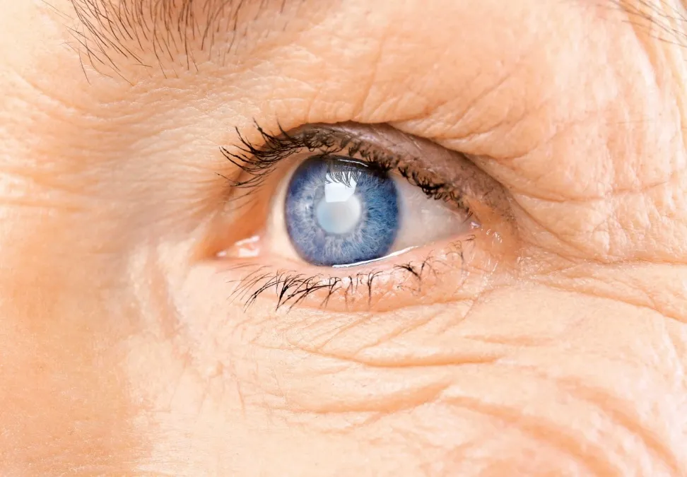 Cataract Surgery Recovery: A Complete Week-by-Week Guide