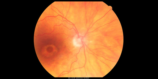 Hydroxychloroquine Eye Screening in Baltimore