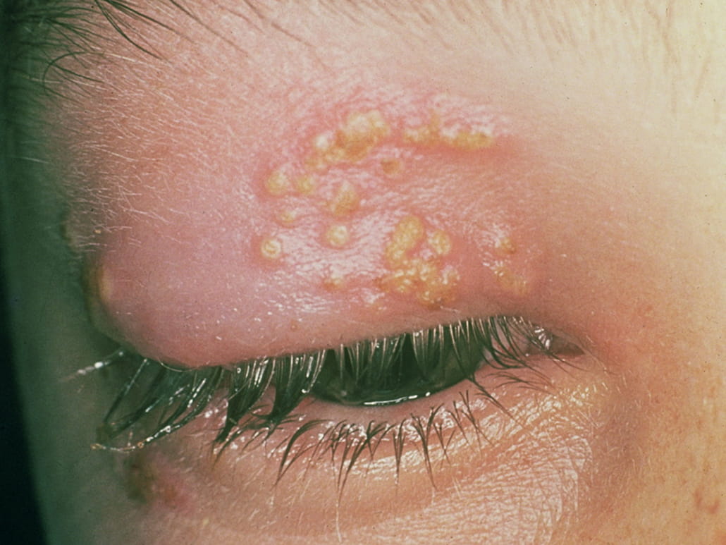 Cataract Surgery in Baltimore With Herpes Eye Disease.
